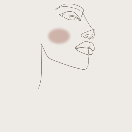 Laser skin treatments for Rosacea 